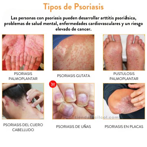 🌿✨Kolmax™ | ⛔️¡ADIÓS PICAZÓN! Tratamiento en aerosol para PSORIASIS