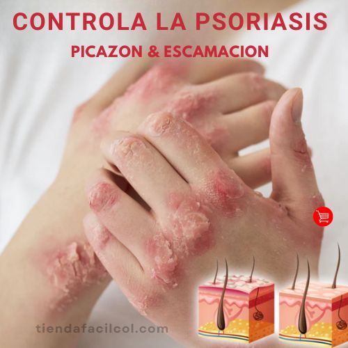 🌿✨Kolmax™ | ⛔️¡ADIÓS PICAZÓN! Tratamiento en aerosol para PSORIASIS