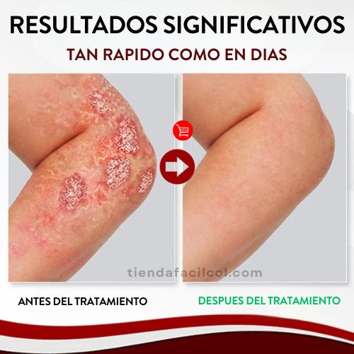 🌿✨Kolmax™ | ⛔️¡ADIÓS PICAZÓN! Tratamiento en aerosol para PSORIASIS